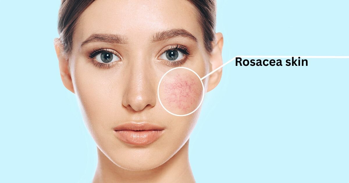 makeup-for-rosacea-skin
